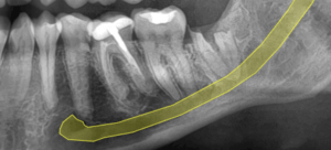 Radiografía de control postoperatorio al año, se evidencia desplazamiento de las raíces.